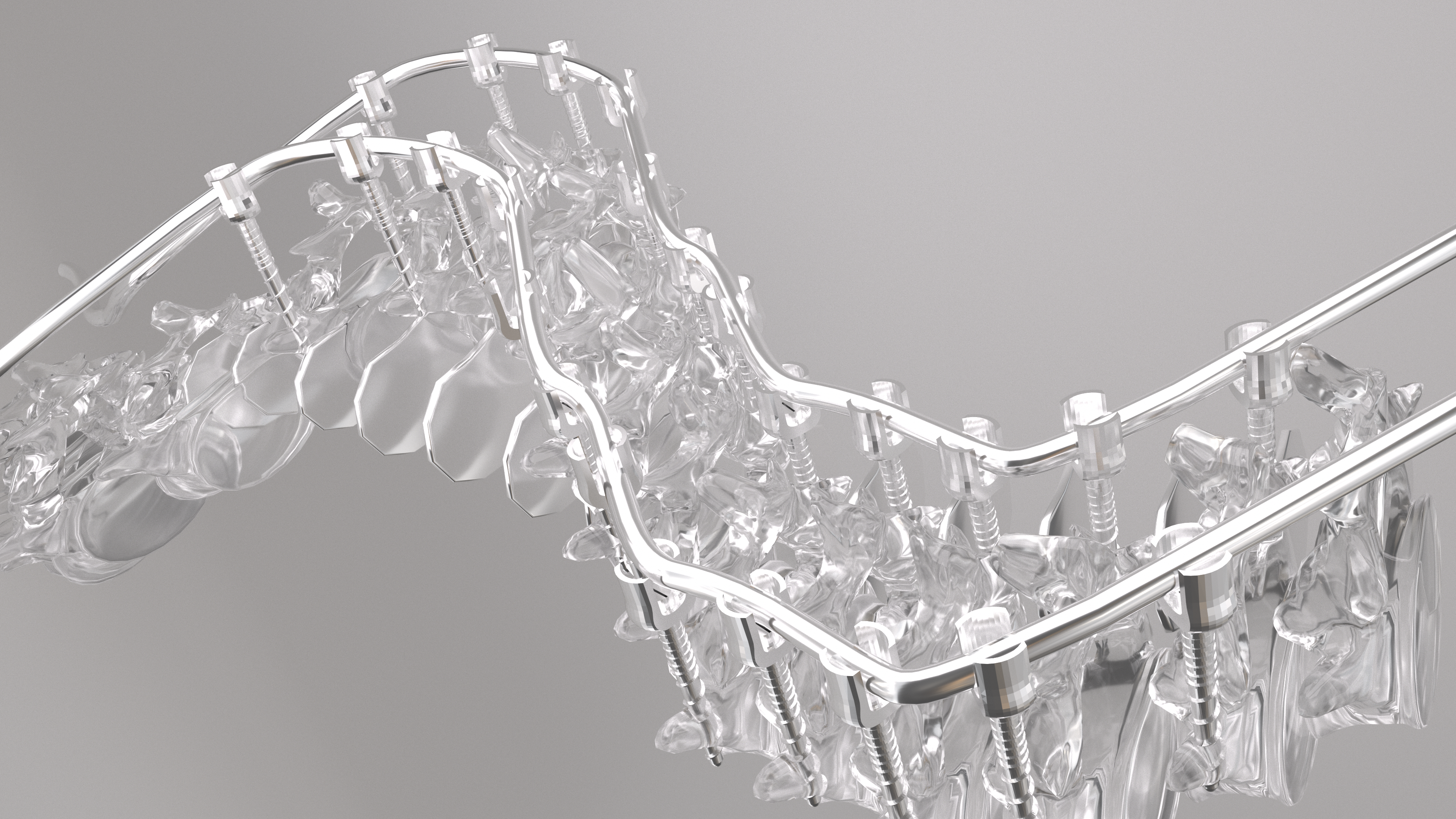 A silver-white spine is slowly being corrected by a metal brace.