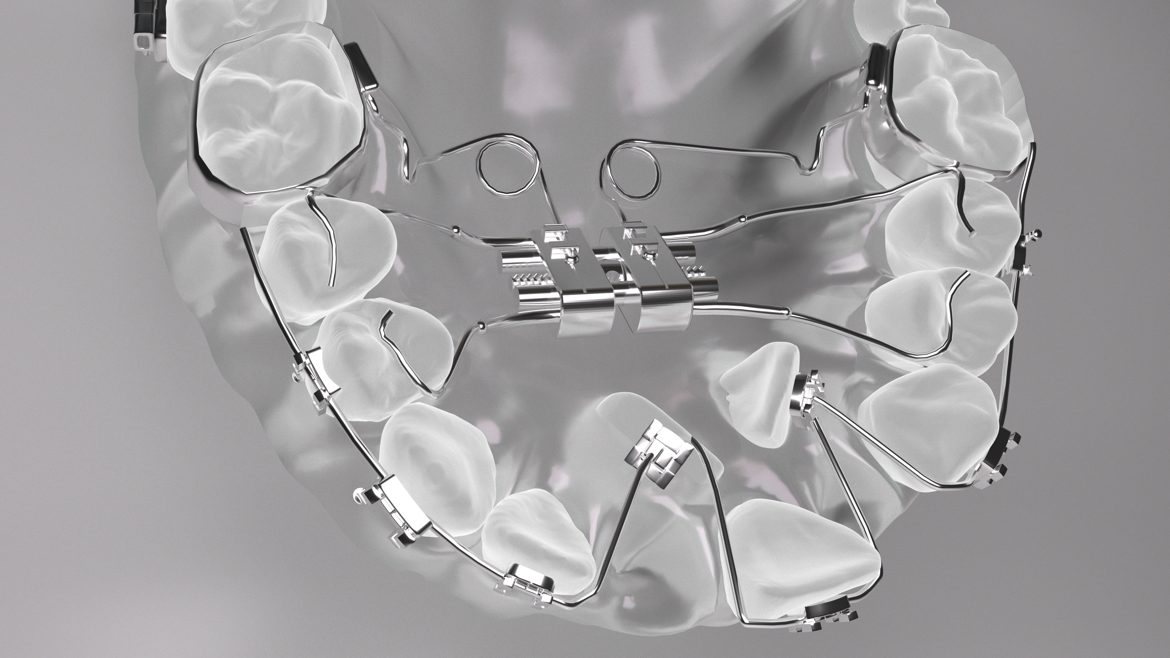 The dental arch and misaligned teeth are slowly being corrected by orthodontic braces.