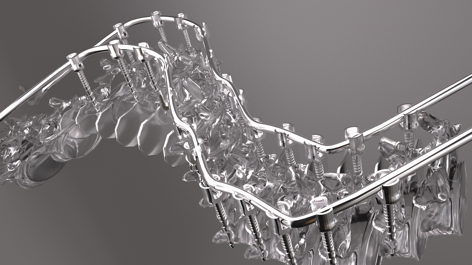 A silver-white spine is slowly being corrected by a metal brace.