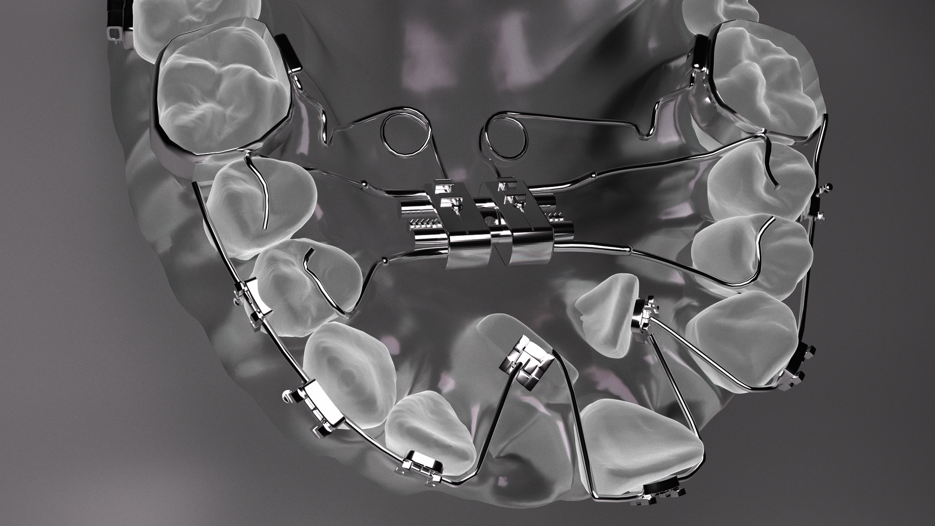 The dental arch and misaligned teeth are slowly being corrected by orthodontic braces.