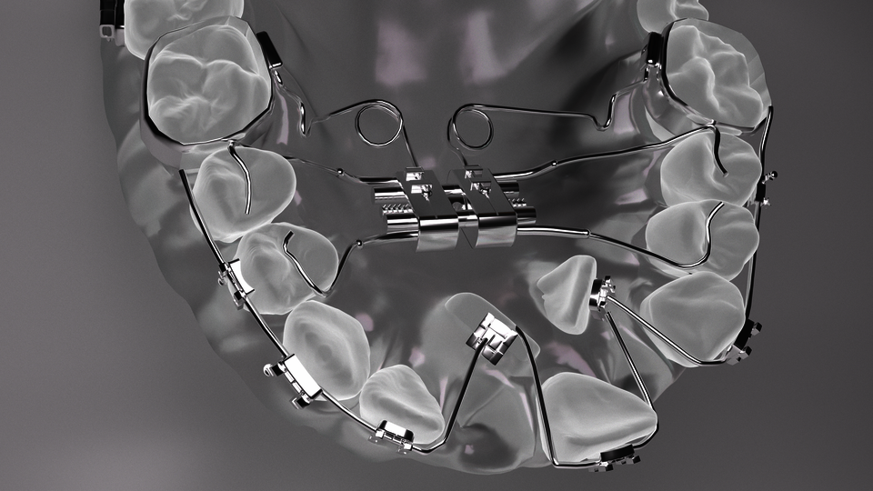 The dental arch and misaligned teeth are slowly being corrected by orthodontic braces.